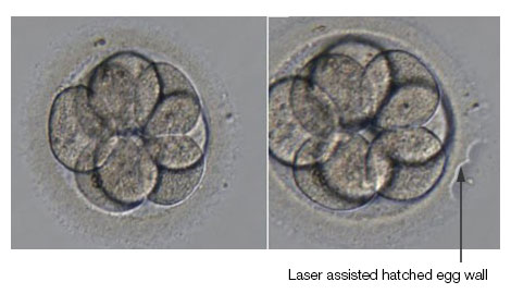 Hỗ trợ phôi thoát màng tại IVF Đại học Y Hà Nội
