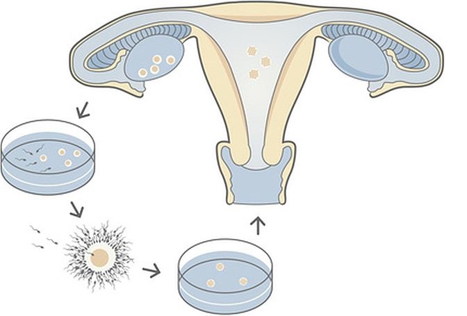 tầm quan trọng của trữ đông trứng trong IVF